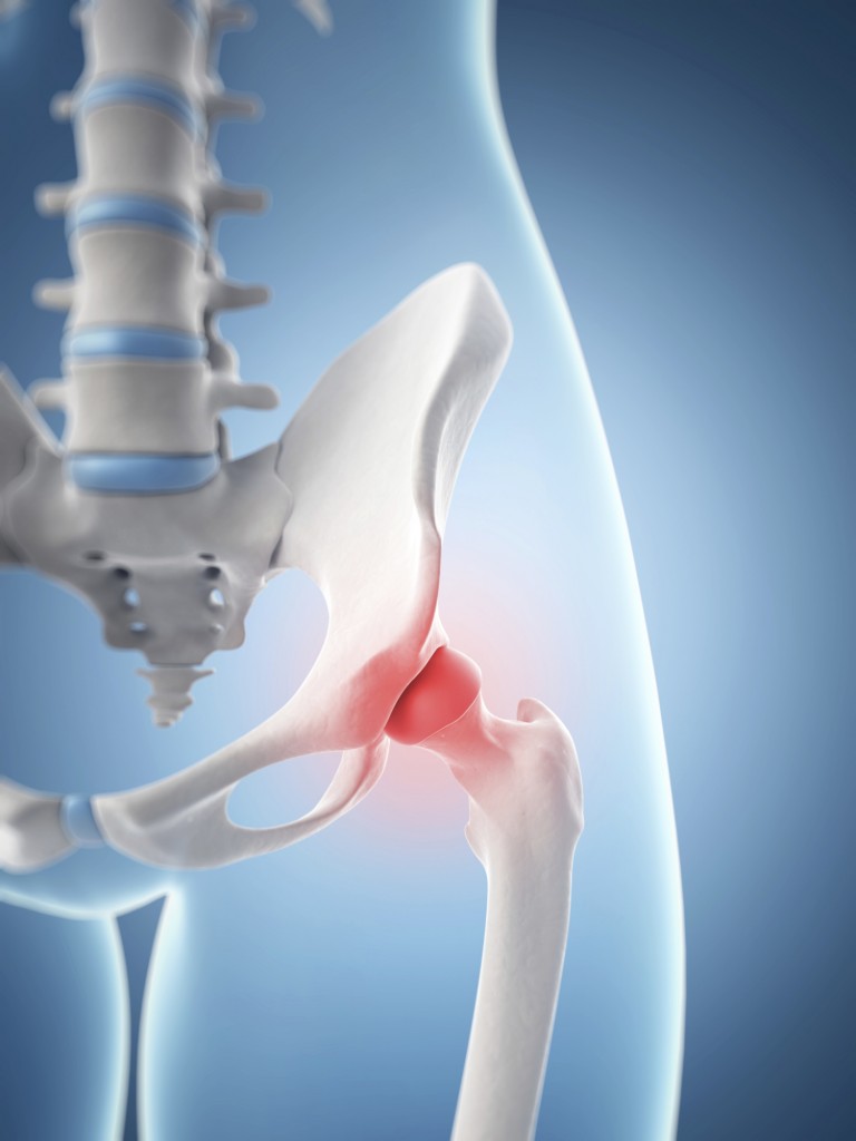 Greater Trochanteric Bursitis Pt Me