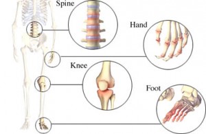 Osteoarthritis physical therapy