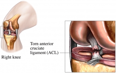 ACL Tears and acl sprain symptoms: Physical therapy for a torn ACL