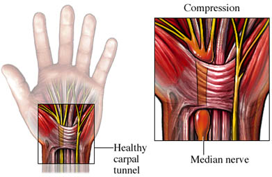 Carpal Tunnel Prevention