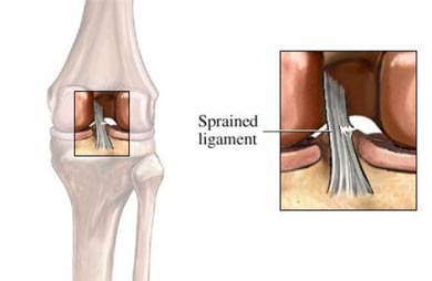 Knee Sprains and Physical therapy for a knee sprain