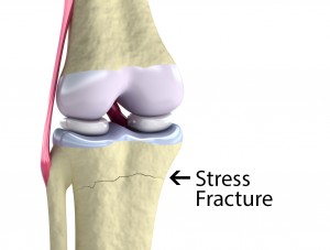 Stress Fracture Knee