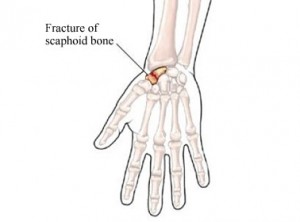 Wrist Fracture - PT & ME