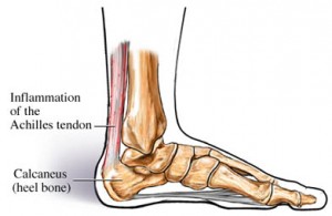 Achilles Tendinitis - PT & ME