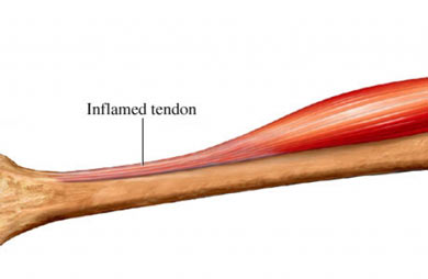 Elbow Tendonitis