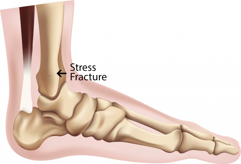 Symptoms of a stress fracture in the foot PTandMe