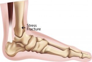 Stress Fracture Ankle: Symptoms of a stress fracture in the foot