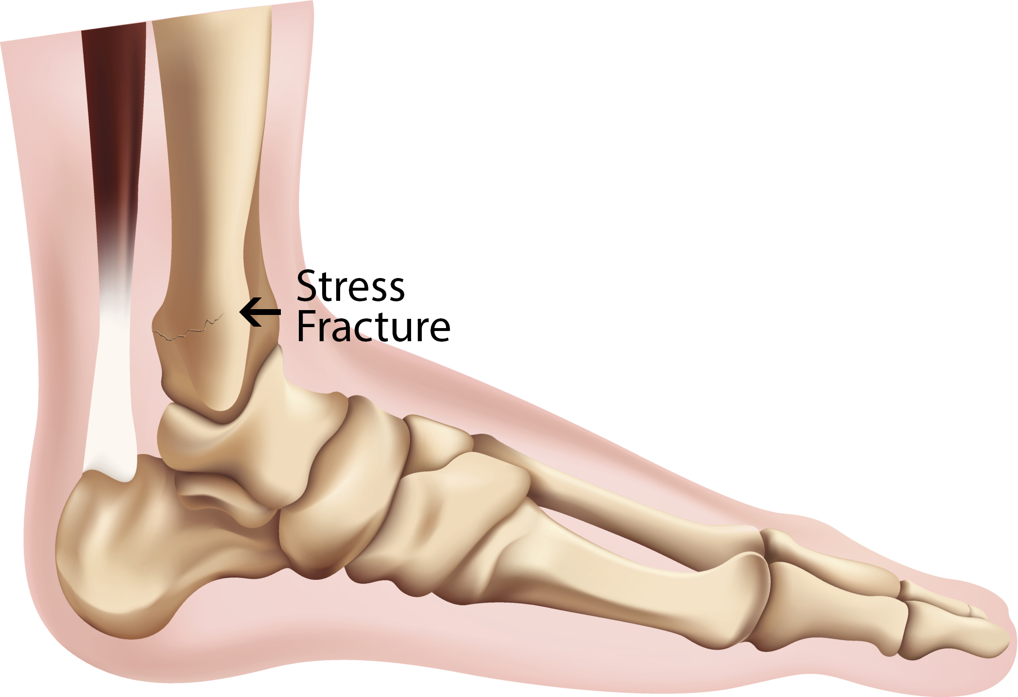Verdikken Gunst Geestelijk Symptoms of a stress fracture in the foot - PTandMe