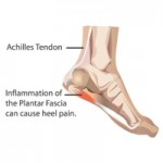 Hamstring Tightness and Plantar Fasciitis - PT & ME