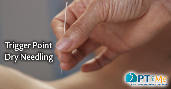Trigger Point dry needling_FBsize