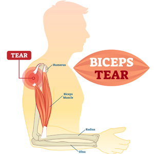 biceps tear