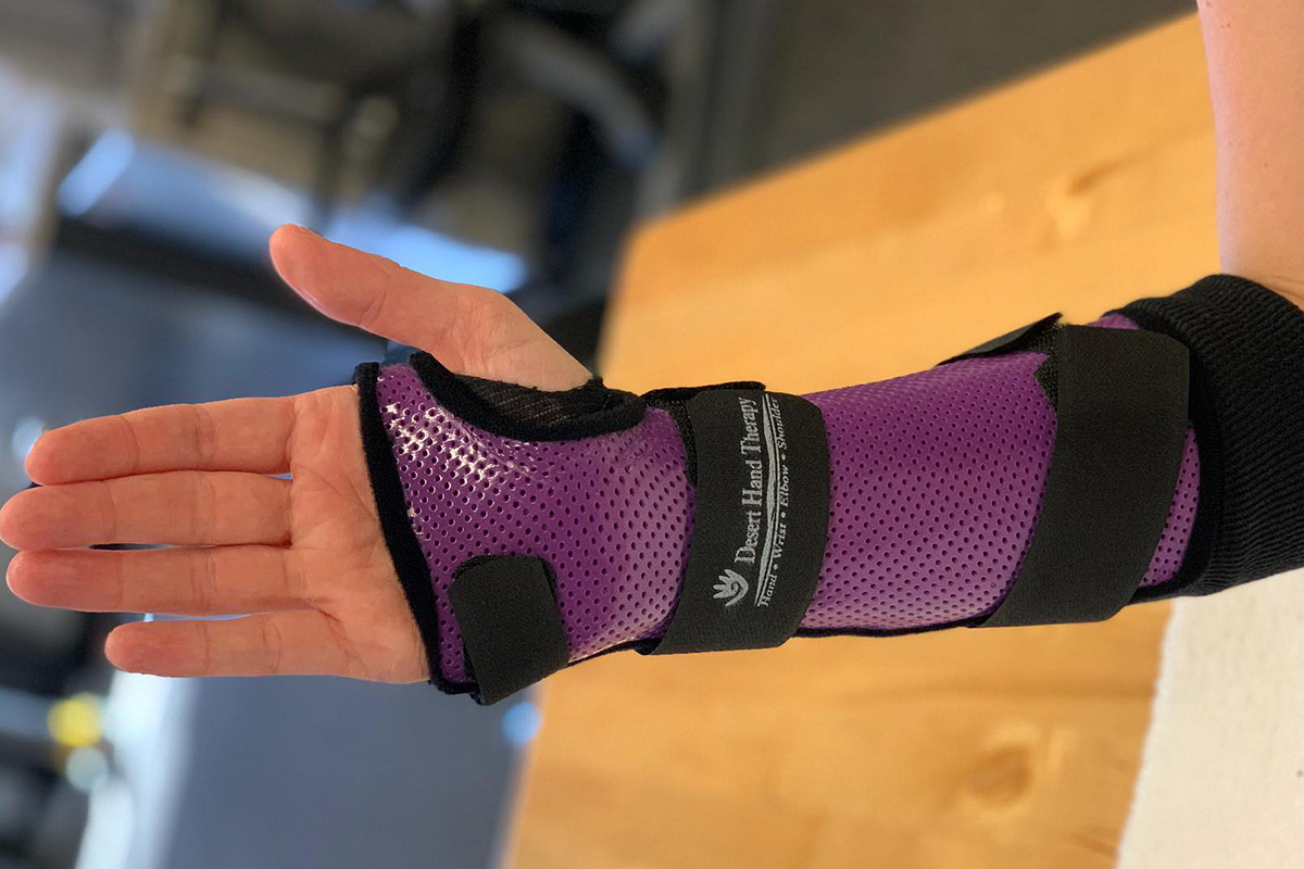 custom splint hand therapy