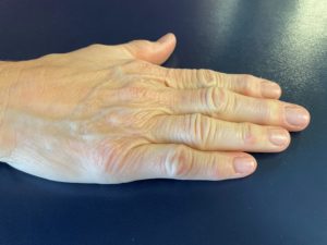 How physical therapy can treat Rheumatoid Arthritis