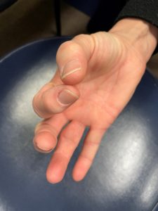 Hand Stretches for Rheumatoid Arthritis