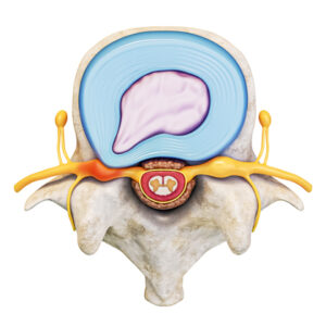 Can Physical Therapy fix a Herniated Disc